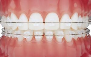 Ordodontie - Aparate dentare