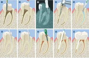 Endodontie - tratamente de canal