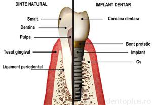 Implantologie - implanturi dentare